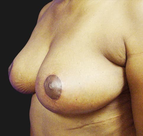 Case 8529 , Performed By Dr. Tehrani – angle 3 After