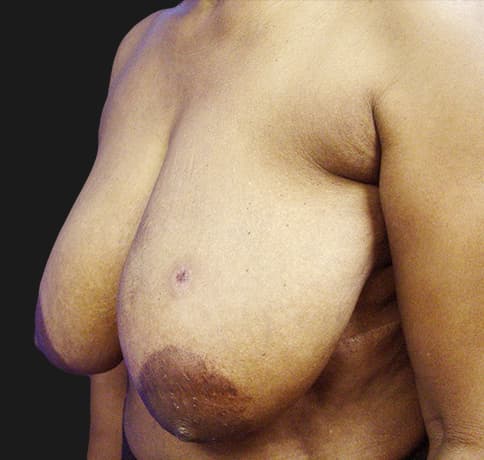 Case 8529 , Performed By Dr. Tehrani – angle 3 Before