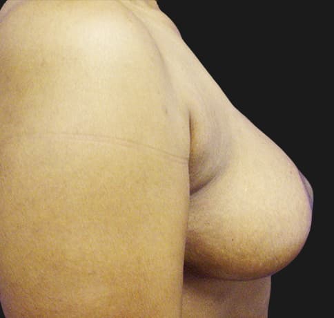 Case 8529 , Performed By Dr. Tehrani – angle 4 After