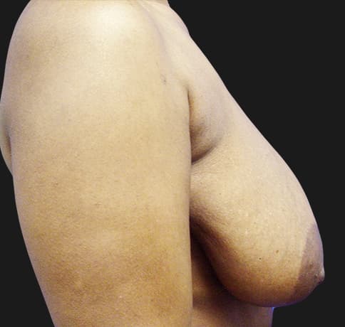 Case 8529 , Performed By Dr. Tehrani – angle 4 Before