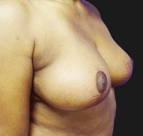 Case 8529 , Performed By Dr. Tehrani – After