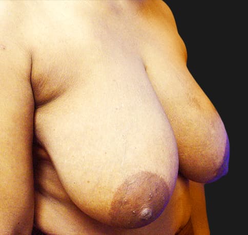 Case 8529 , Performed By Dr. Tehrani – Before