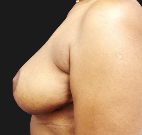 Case 8529 , Performed By Dr. Tehrani – angle 5 After