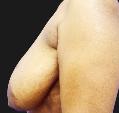 Case 8529 , Performed By Dr. Tehrani – angle 5 Before