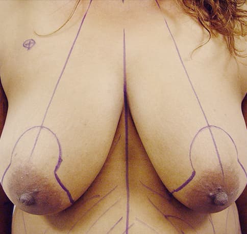 Case 7122 , Performed By Dr. Tehrani – Before