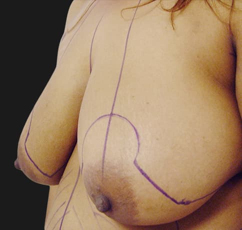 Case 7122 , Performed By Dr. Tehrani – angle 3 Before