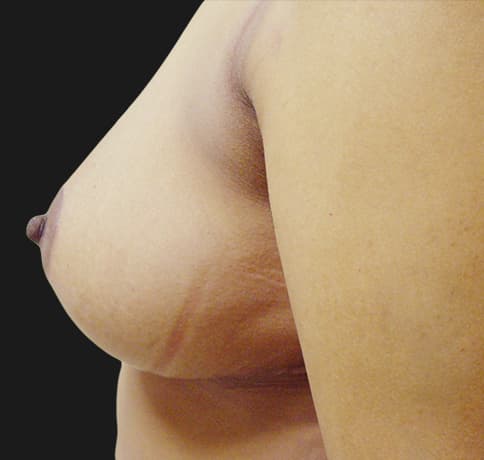 Case 7122 , Performed By Dr. Tehrani – angle 4 After