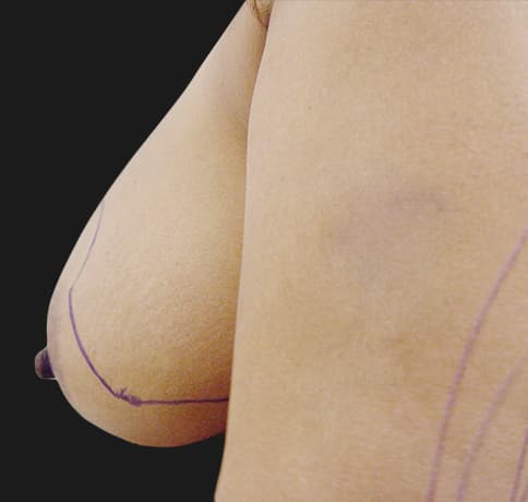 Case 7122 , Performed By Dr. Tehrani – angle 4 Before
