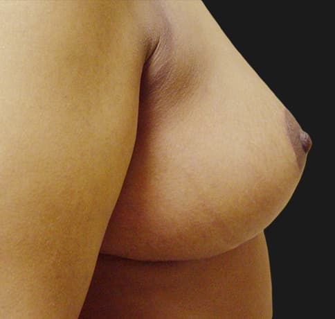 Case 7122 , Performed By Dr. Tehrani – angle 5 After