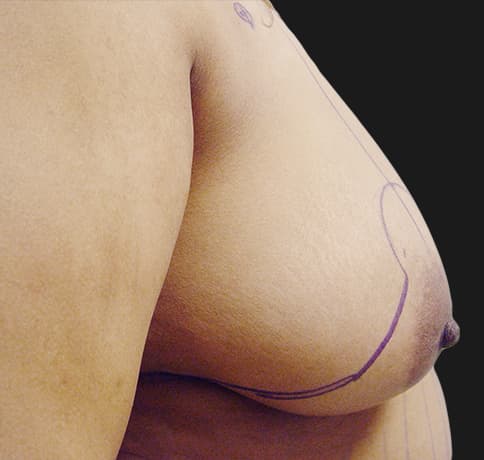 Case 7122 , Performed By Dr. Tehrani – angle 5 Before