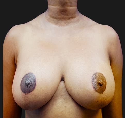 Case 20439 , Performed By Dr. Tehrani – After