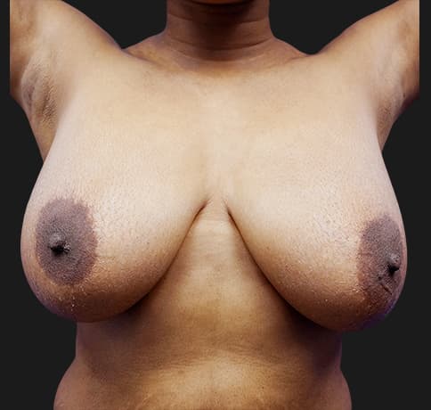 Case 20439 , Performed By Dr. Tehrani – Before