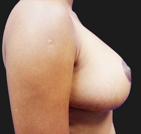 Case 20439 , Performed By Dr. Tehrani – angle 3 After