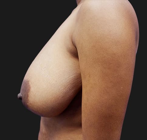 Case 20439 , Performed By Dr. Tehrani – angle 3 Before