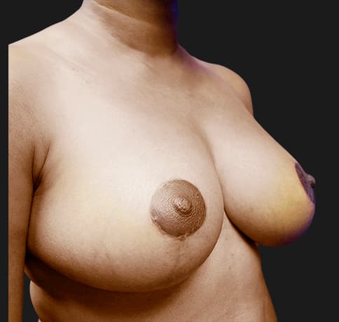 Case 20439 , Performed By Dr. Tehrani – After