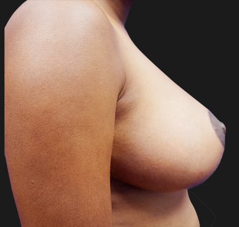 Case 20439 , Performed By Dr. Tehrani – angle 4 After