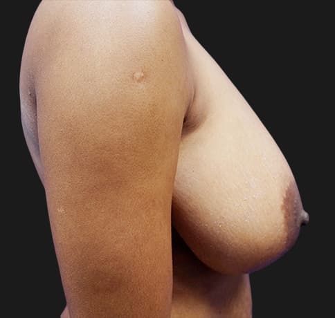 Case 20439 , Performed By Dr. Tehrani – angle 4 Before