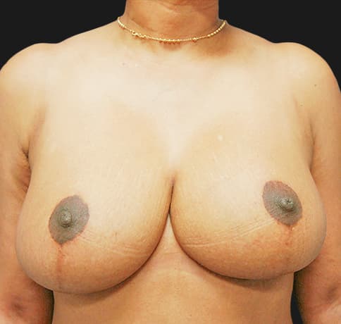 Case 13950 , Performed By Dr. Tehrani – After