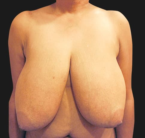 Case 13950 , Performed By Dr. Tehrani – Before