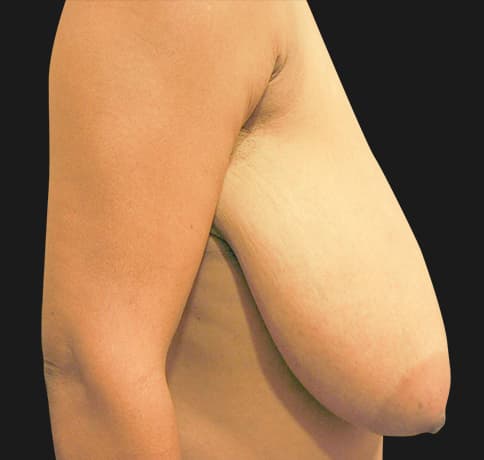 Case 13950 , Performed By Dr. Tehrani – angle 4 Before