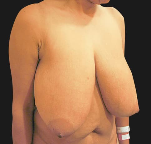 Case 13950 , Performed By Dr. Tehrani – Before