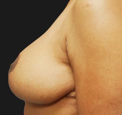 Case 13950 , Performed By Dr. Tehrani – angle 5 After