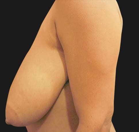 Case 13950 , Performed By Dr. Tehrani – angle 5 Before
