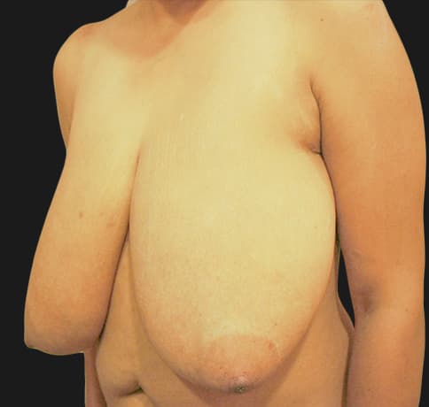 Case 13950 , Performed By Dr. Tehrani – angle 3 Before
