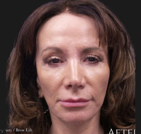 Case 16813, Performed By Dr. Tehrani – After