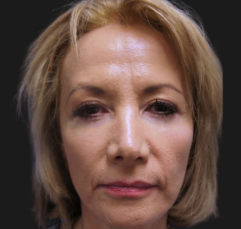 Case 16813, Performed By Dr. Tehrani – Before