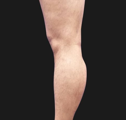 Case 41765, Performed By Dr. Tehrani – After