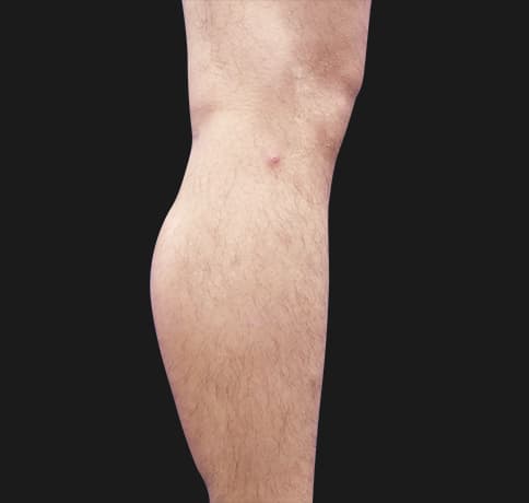 Case 41765, Performed By Dr. Tehrani – After