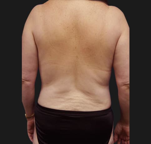Case 11269 , Performed By Dr. Tehrani – After