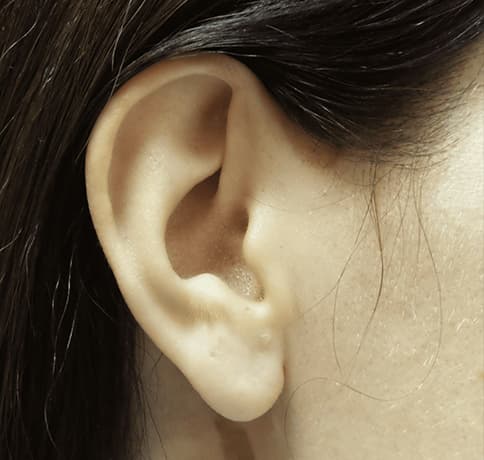 Case 30339 , Performed By Dr. Tehrani – After