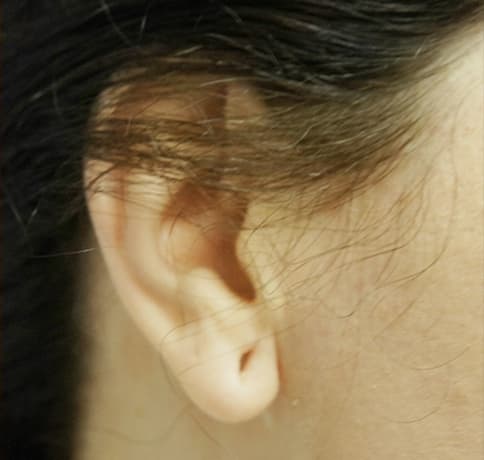 Case 30339 , Performed By Dr. Tehrani – Before