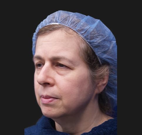 Case 33290, Performed By Dr. Tehrani – angle 3 Before
