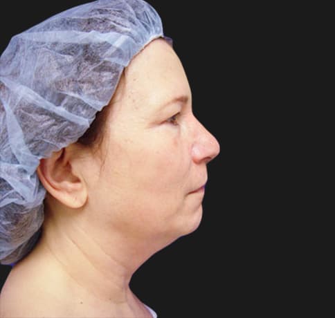 Case 120, Performed By Dr. Tehrani – Before