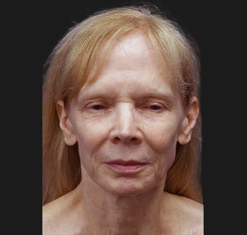 Case 7824 , Performed By Dr. Tehrani – angle 3 Before