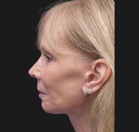 Case 7824 , Performed By Dr. Tehrani – After