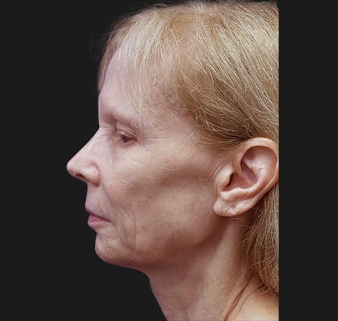 Case 7824 , Performed By Dr. Tehrani – Before