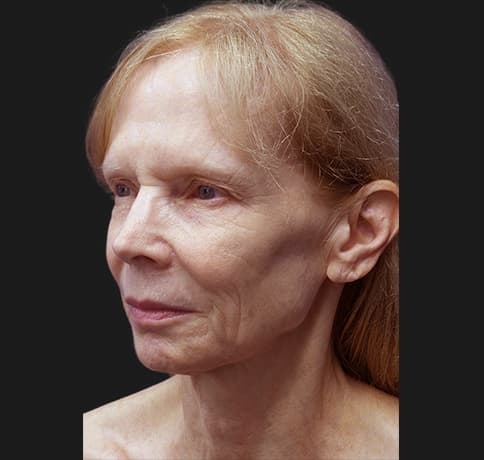Case 7824 , Performed By Dr. Tehrani – angle 4 Before