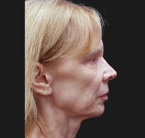 Case 7824 , Performed By Dr. Tehrani – Before