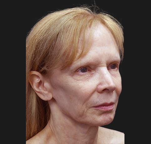 Case 7824 , Performed By Dr. Tehrani – angle 5 Before