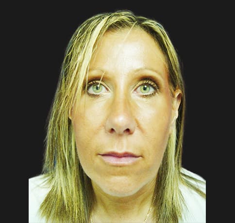 Case 2115 , Performed By Dr. Tehrani – angle 3 After