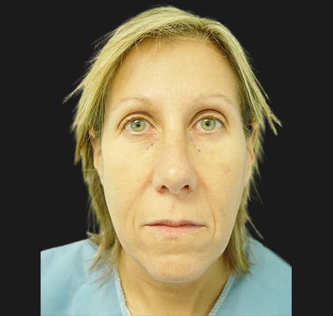 Case 2115 , Performed By Dr. Tehrani – angle 3 Before