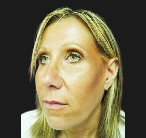 Case 2115 , Performed By Dr. Tehrani – angle 4 After
