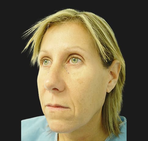 Case 2115 , Performed By Dr. Tehrani – angle 4 Before