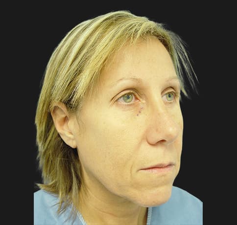 Case 2115 , Performed By Dr. Tehrani – angle 5 Before