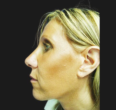 Case 2115 , Performed By Dr. Tehrani – After