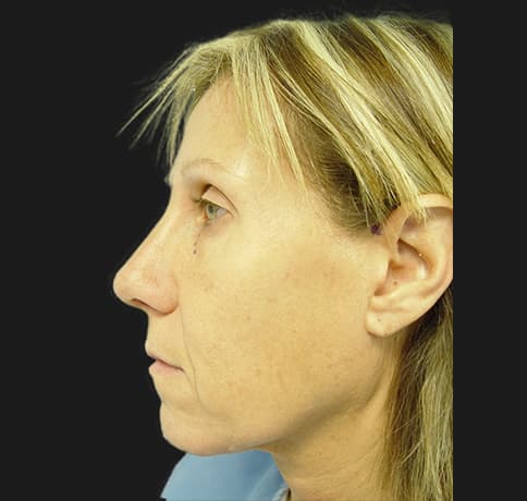 Case 2115 , Performed By Dr. Tehrani – Before
